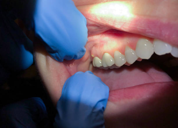 Best Dentist for Tooth Abscess  in Marshall, MN